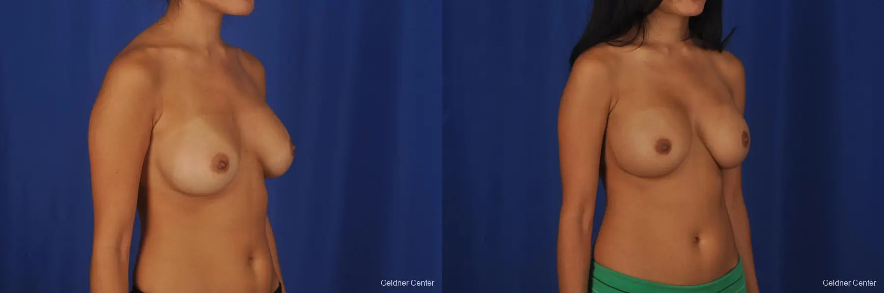Breast Augmentation Streeterville, Chicago 2298 - Before and After 3