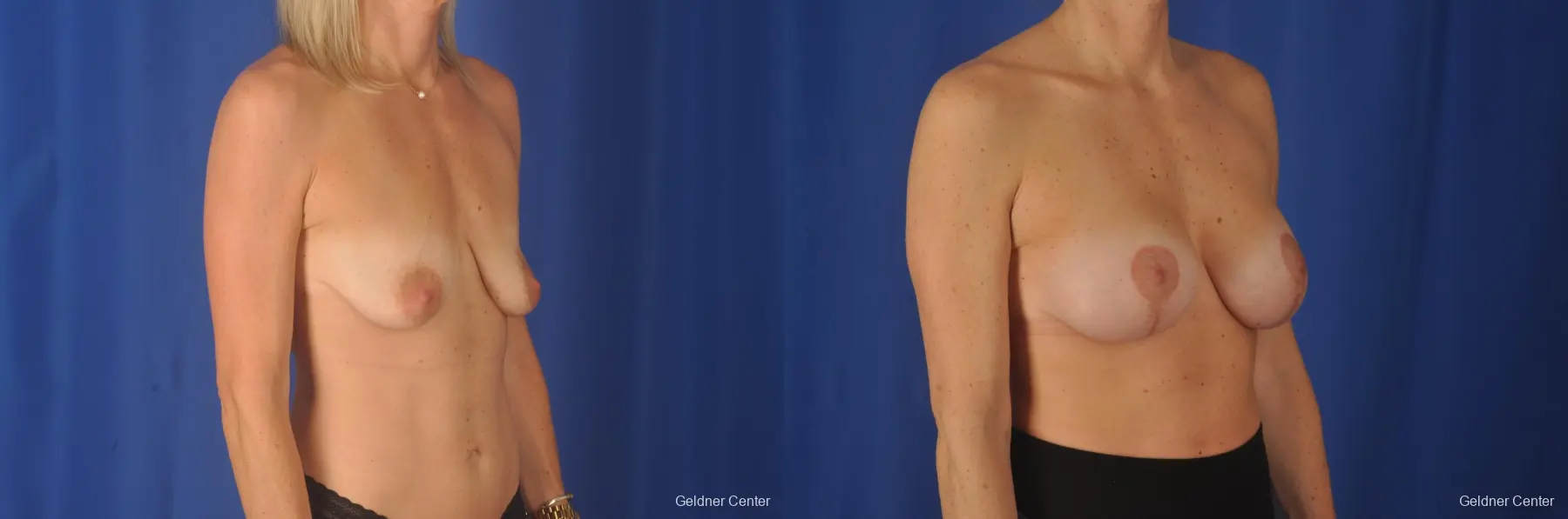 Breast Augmentation: Patient 80 - Before and After 3