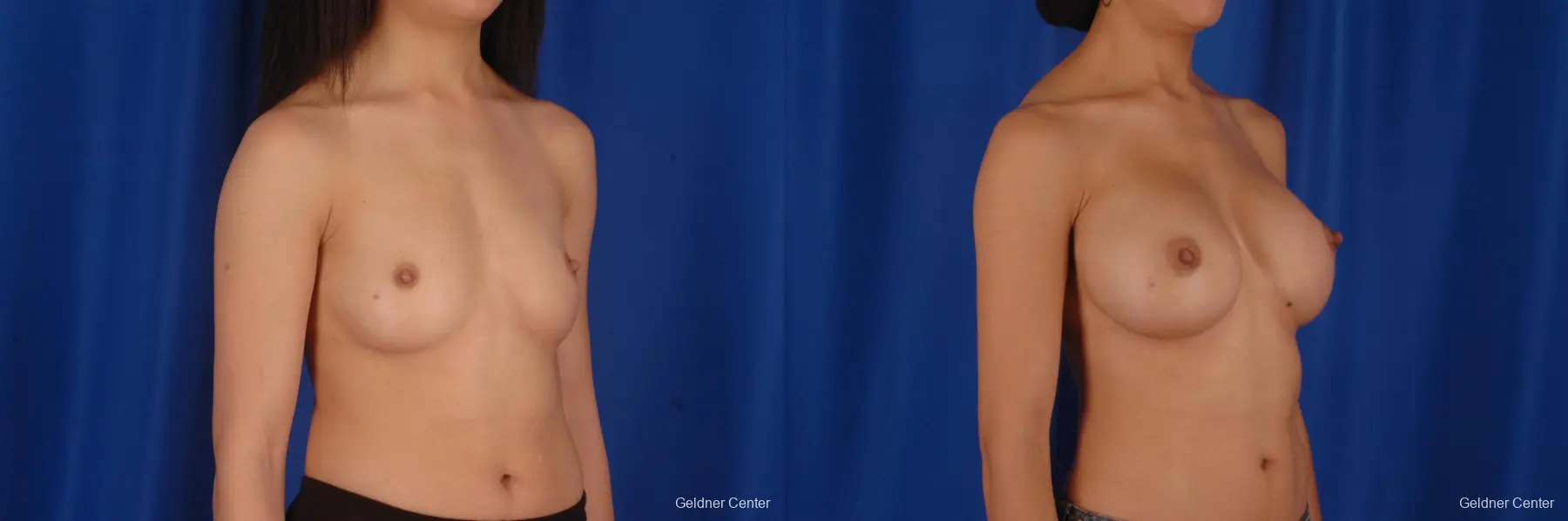 Chicago Breast Augmentation 2339 - Before and After 3