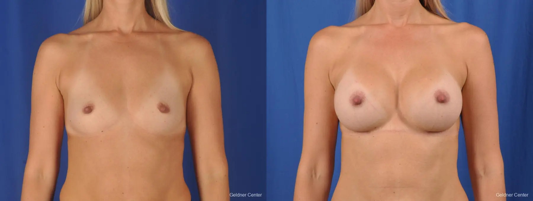 Breast Augmentation: Patient 149 - Before and After 1