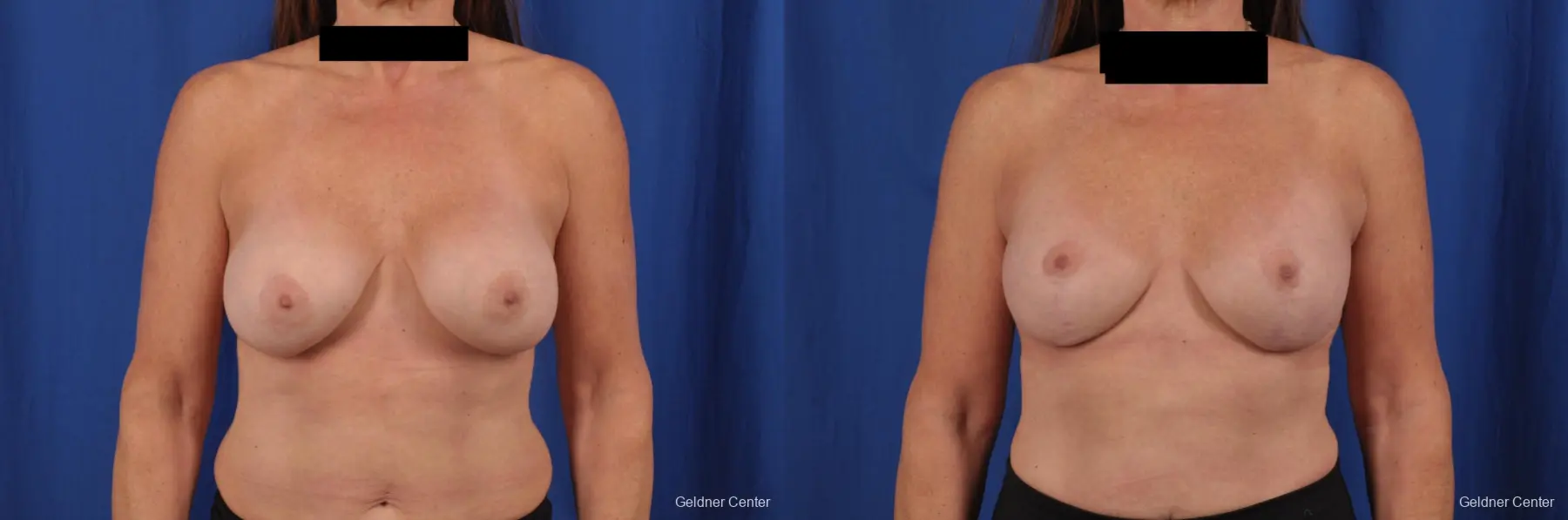 Breast Augmentation: Patient 154 - Before and After 1