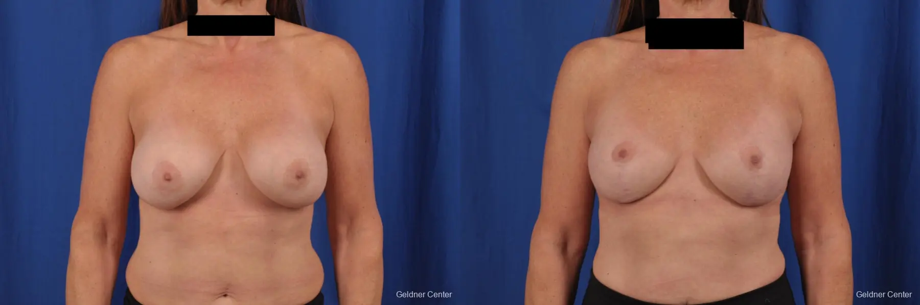 Removal do textured implants, subpectoral placement, vertical mastopexy - Before and After