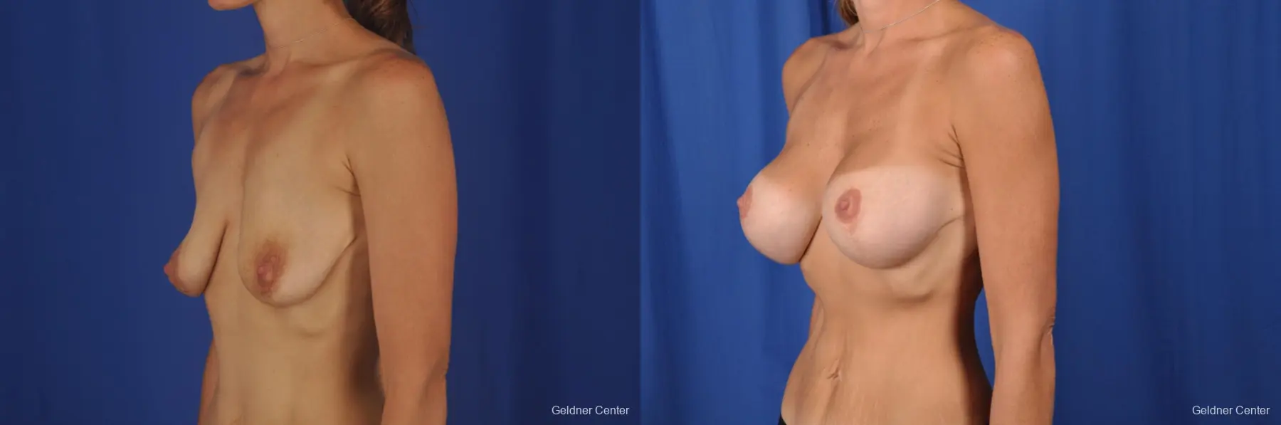 Breast Augmentation: Patient 158 - Before and After 4