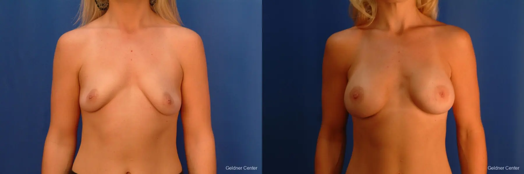 Breast Augmentation Lake Shore Dr, Chicago 2350 - Before and After