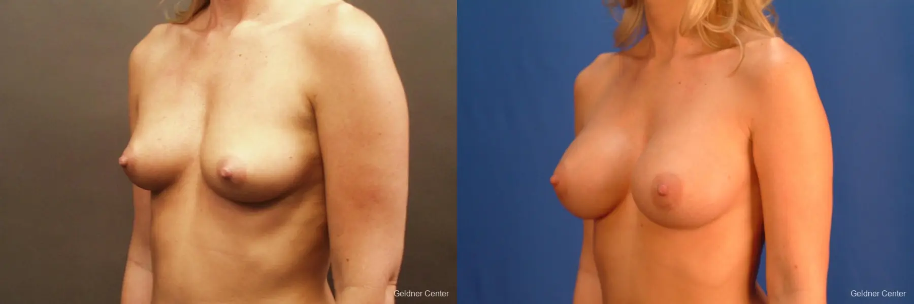 Breast Augmentation Streeterville, Chicago 2425 - Before and After 4