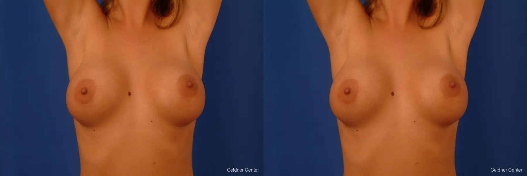 Breast Augmentation Lake Shore Dr, Chicago 2533 - Before and After 5