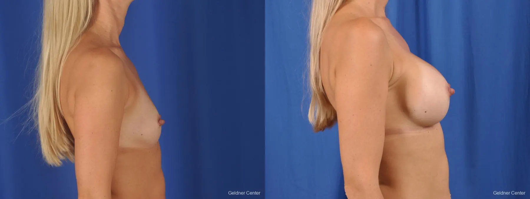 Breast Augmentation: Patient 149 - Before and After 3
