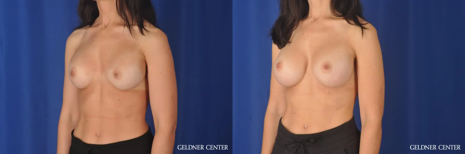 Breast Augmentation: Patient 142 - Before and After 4