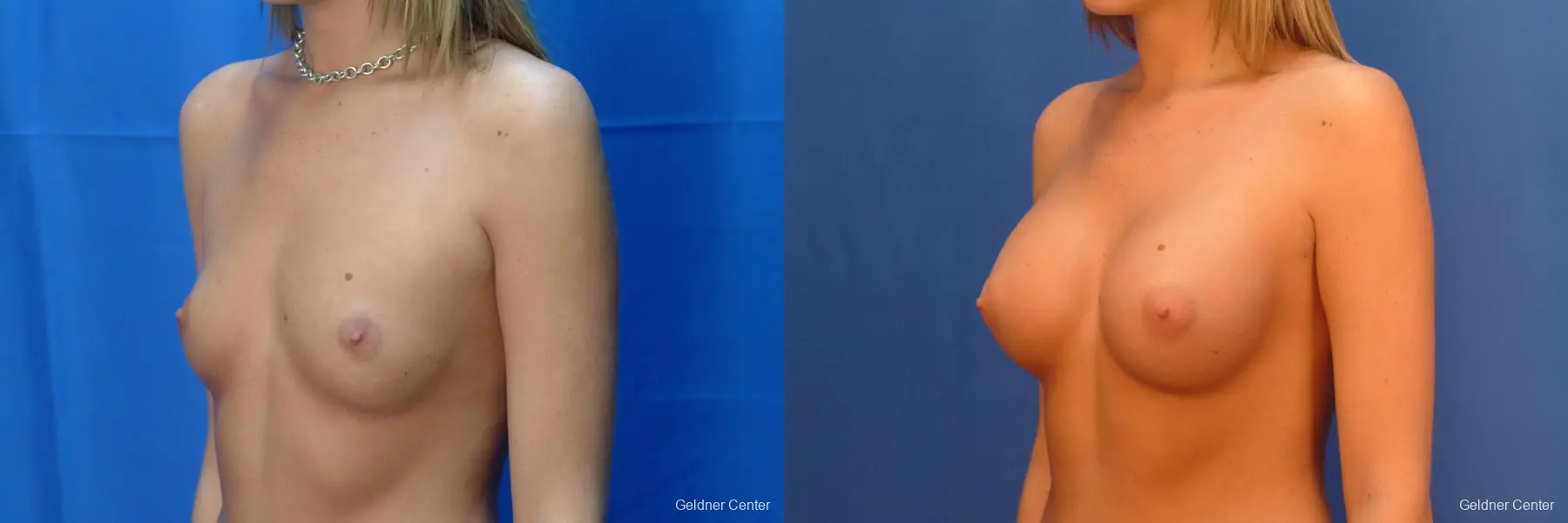 Chicago Breast Augmentation 2431 - Before and After 4