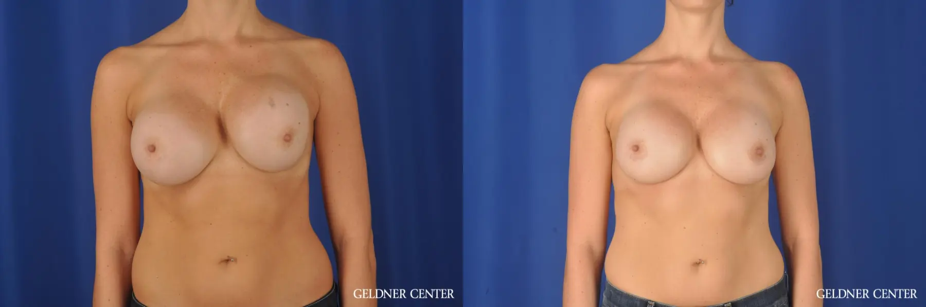 Highly Cohesive Gel Implant Before and After Photos - Before and After