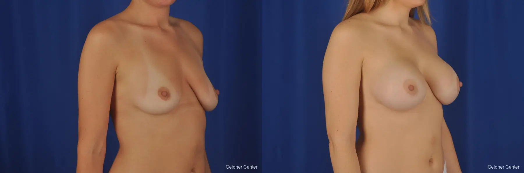 Chicago Breast Augmentation 2374 - Before and After 3
