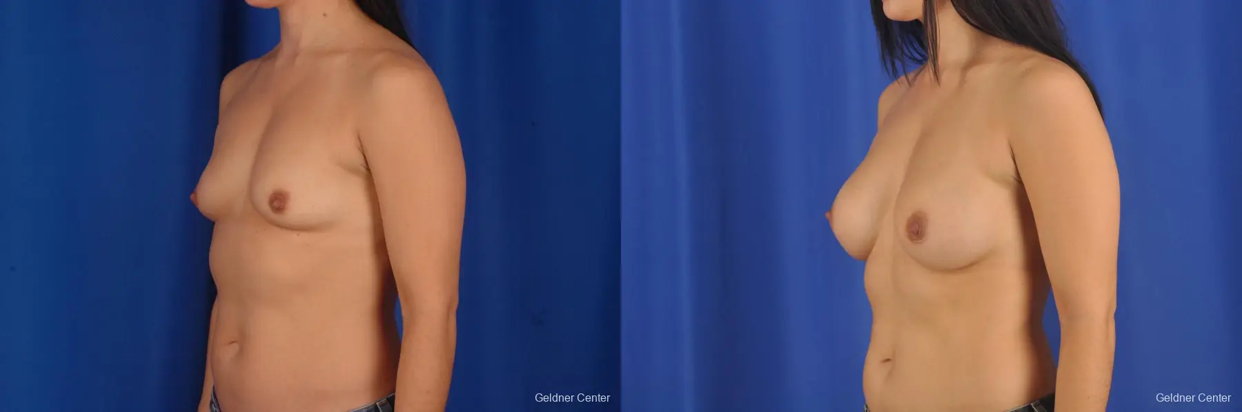 Breast Augmentation Hinsdale, Chicago 2299 - Before and After 4