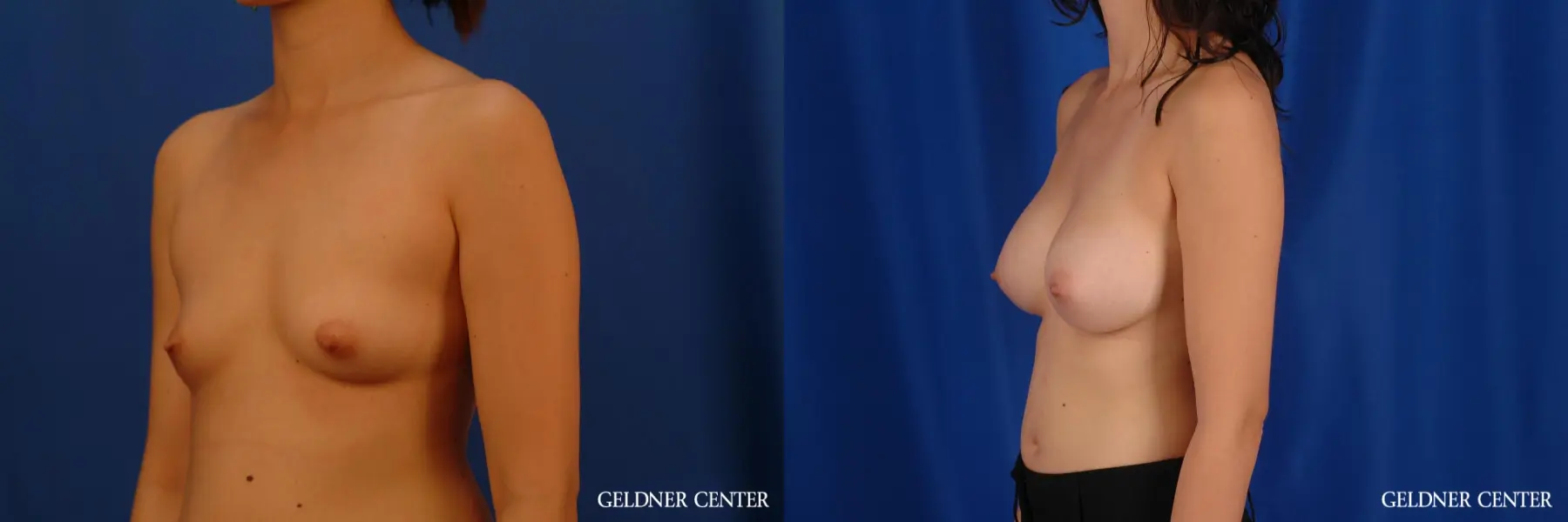 Breast Augmentation: Patient 178 - Before and After 4