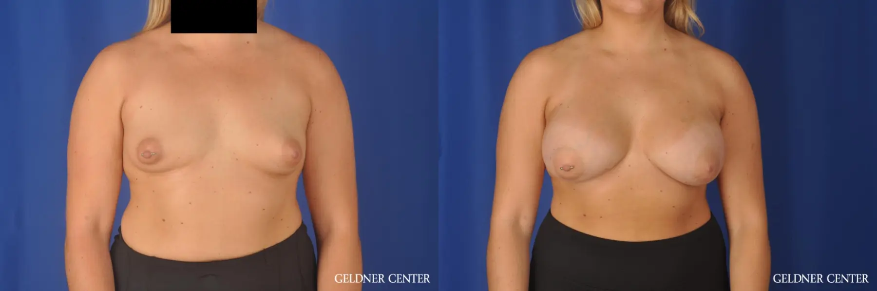 Breast Augmentation: Patient 180 - Before and After 1