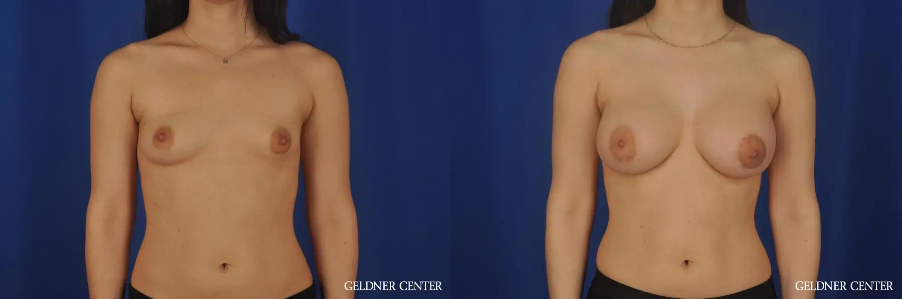 Breast Augmentation Hinsdale 5472 - Before and After