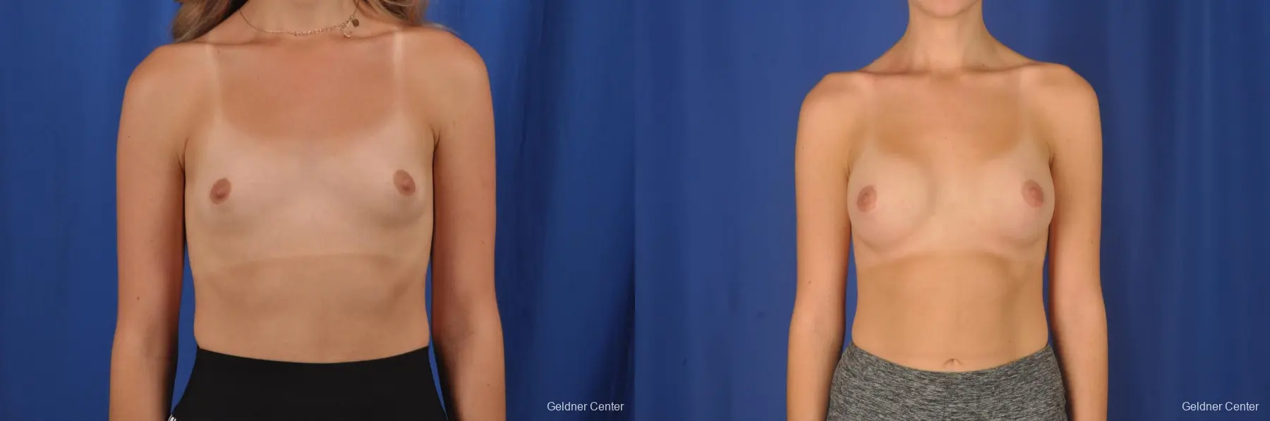 Endoscopic Transaxillary Subpectoral Breast Augmentation 250cc - Before and After