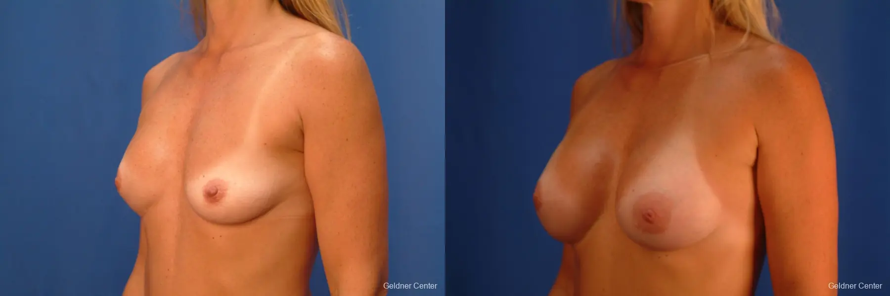 Breast Augmentation Lake Shore Dr, Chicago 2418 - Before and After 3