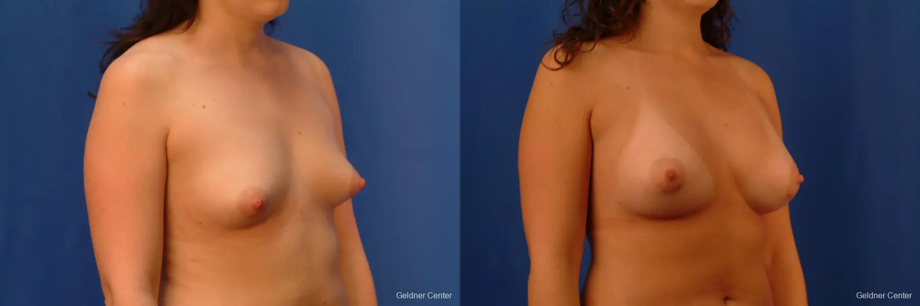 Chicago Breast Augmentation 2517 - Before and After 3
