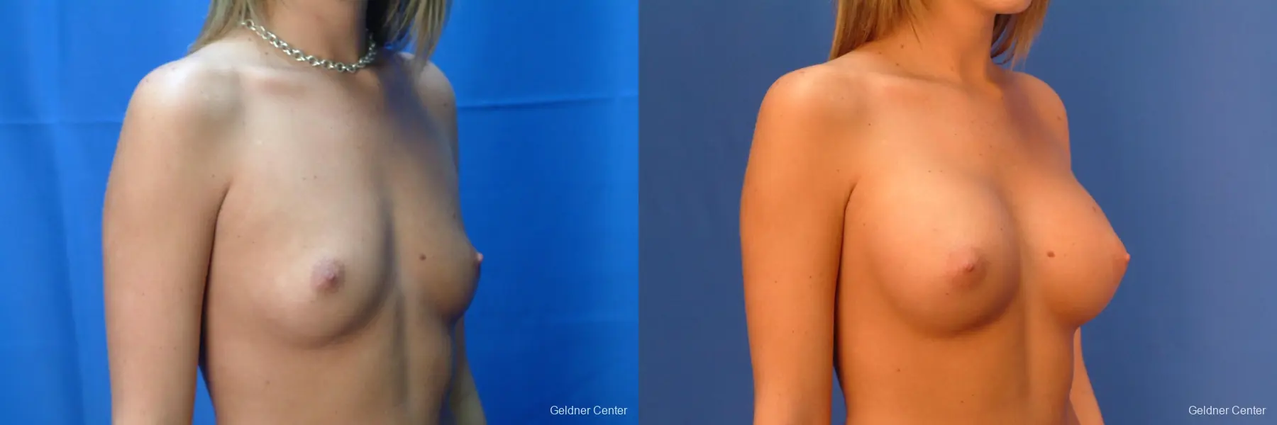 Chicago Breast Augmentation 2431 - Before and After 3