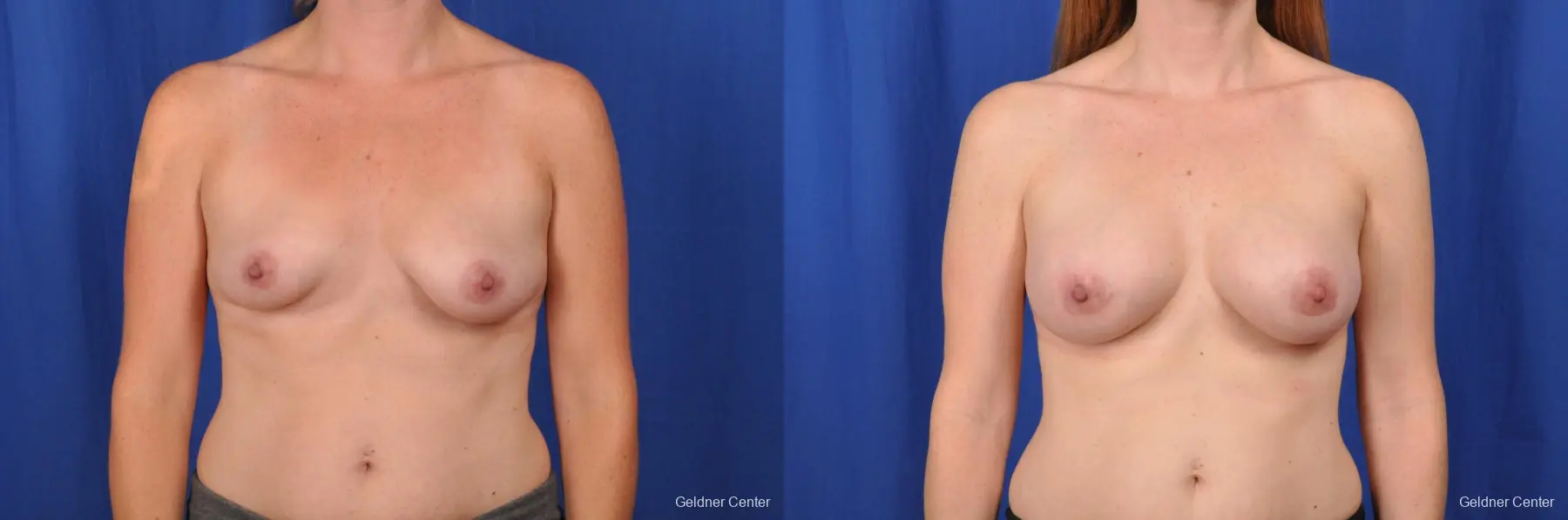 Breast Augmentation Hinsdale, Chicago 2531 - Before and After 1