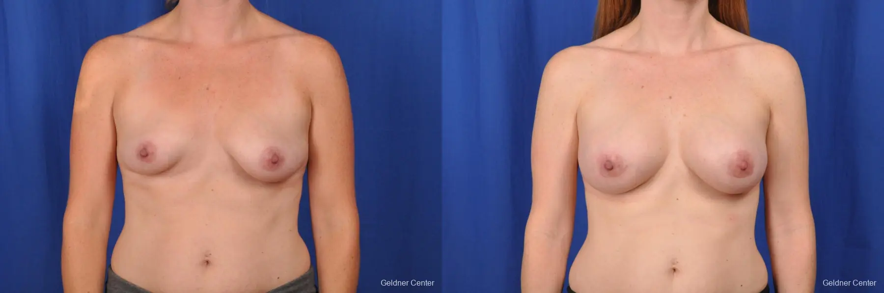 Breast Augmentation Hinsdale, Chicago 2531 - Before and After