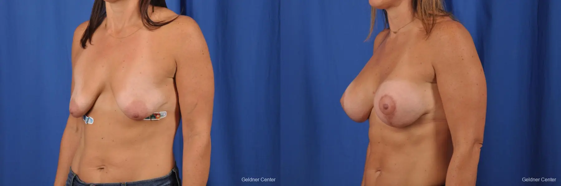 Breast Augmentation: Patient 151 - Before and After 4