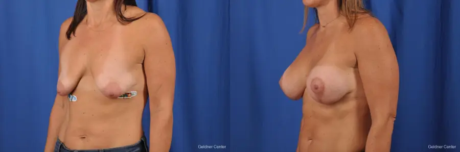 Breast Augmentation: Patient 150 - Before and After 4