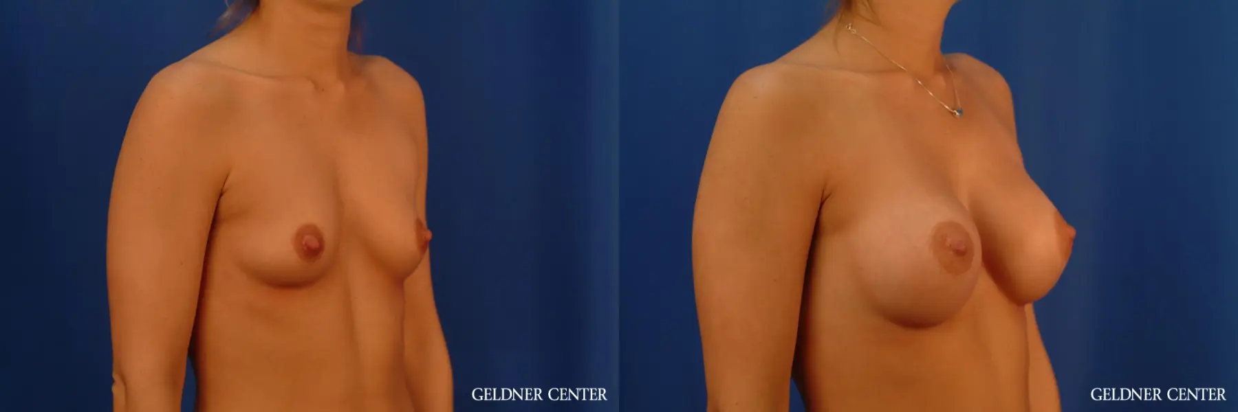 Breast Augmentation: Patient 182 - Before and After 2
