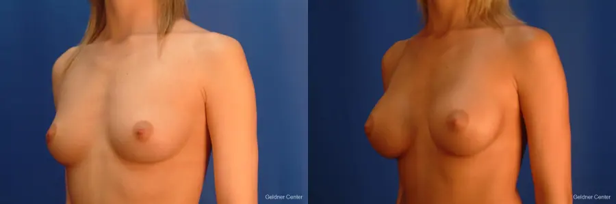 Chicago Breast Augmentation 2523 - Before and After 4