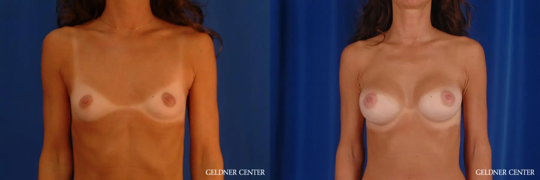 Periareolar Biplanar Subpectoral Breast Augmentation 250cc - Before and After