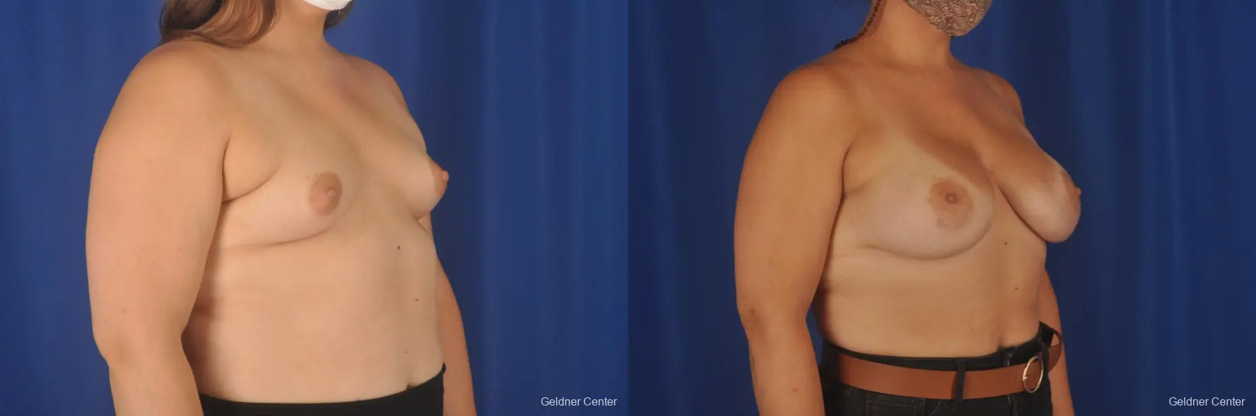 Breast Augmentation: Patient 190 - Before and After 3