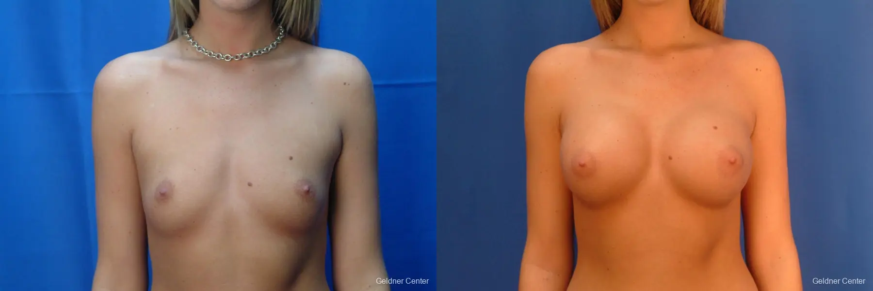 Chicago Breast Augmentation 2431 - Before and After 1