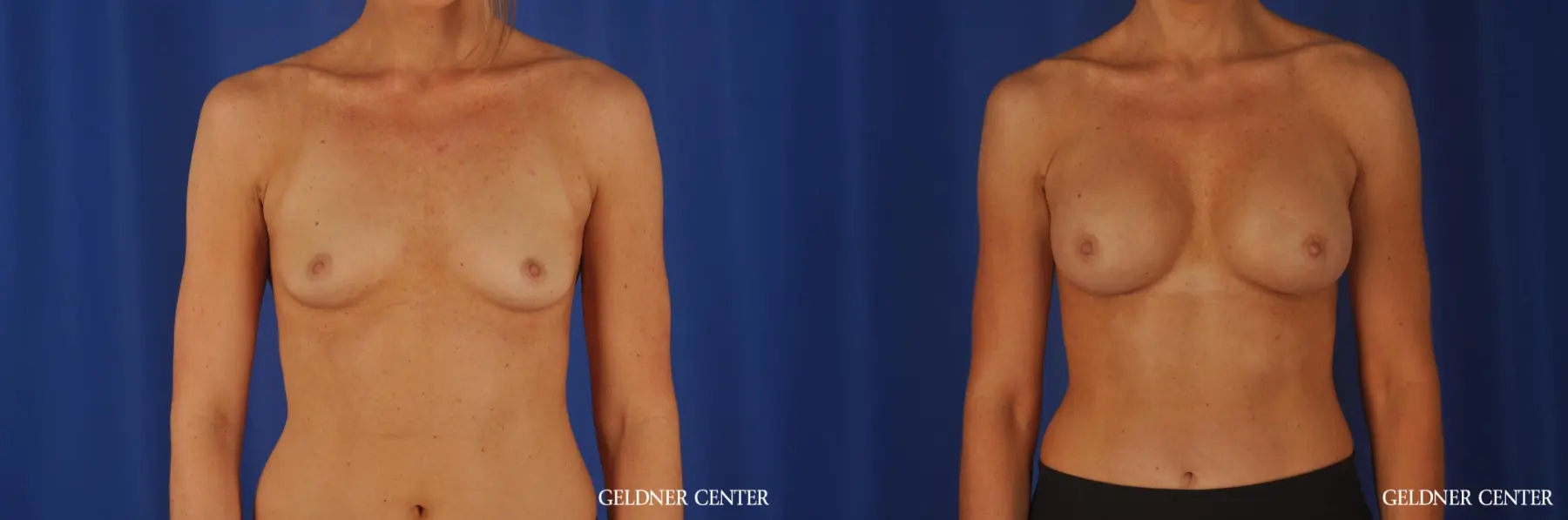 Chicago Breast Augmentation 8745 - Before and After