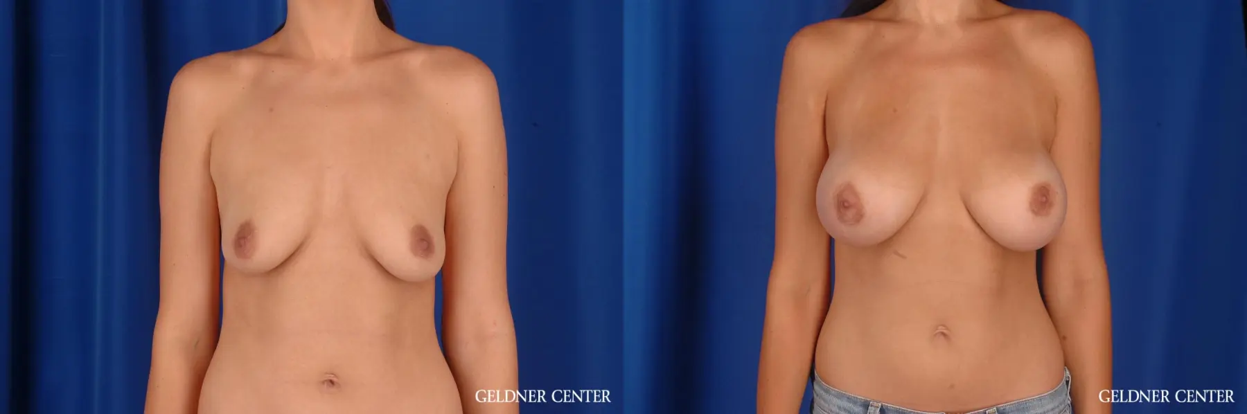 Breast Augmentation: Patient 170 - Before and After 1