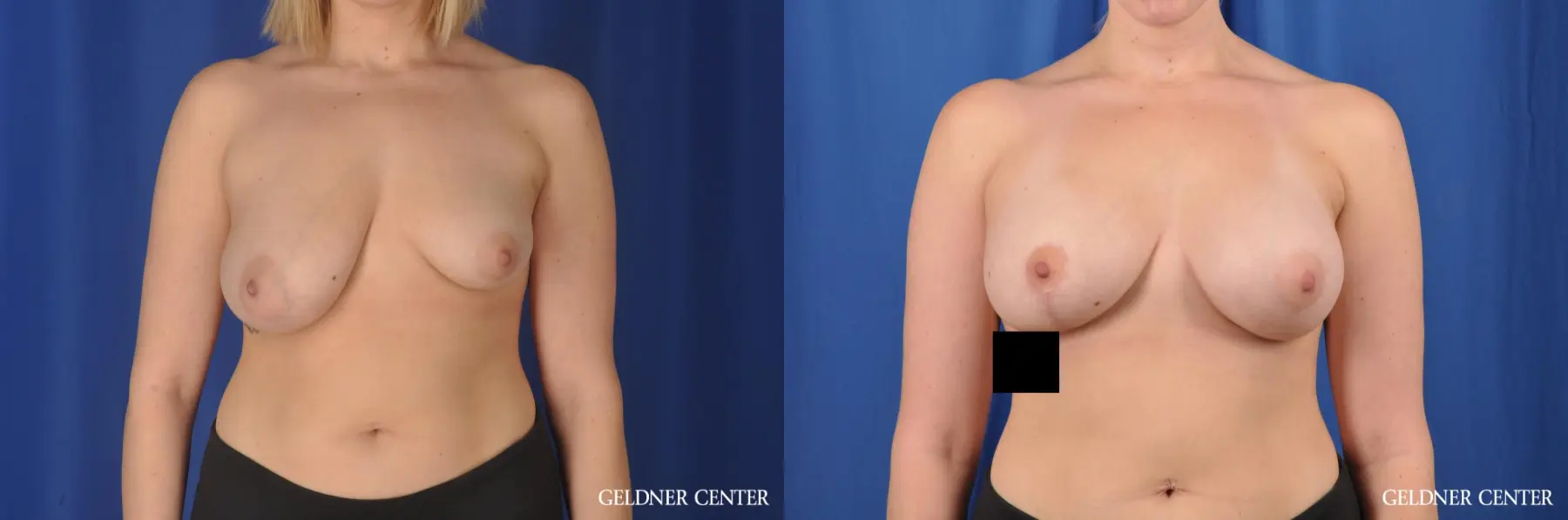 Biplanar Subpectoral with Unilateral Augmentation 250cc - Before and After
