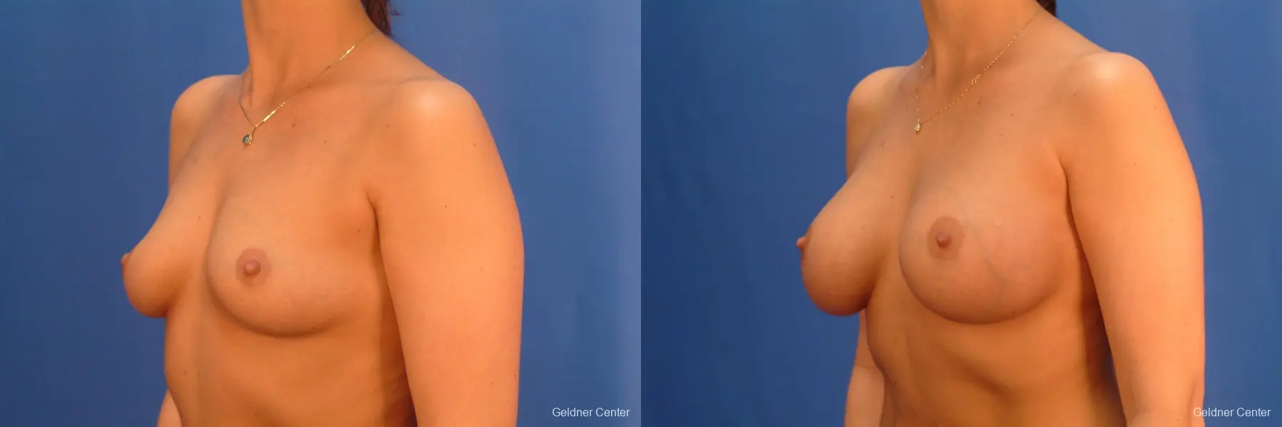 Chicago Breast Augmentation 2432 - Before and After 4