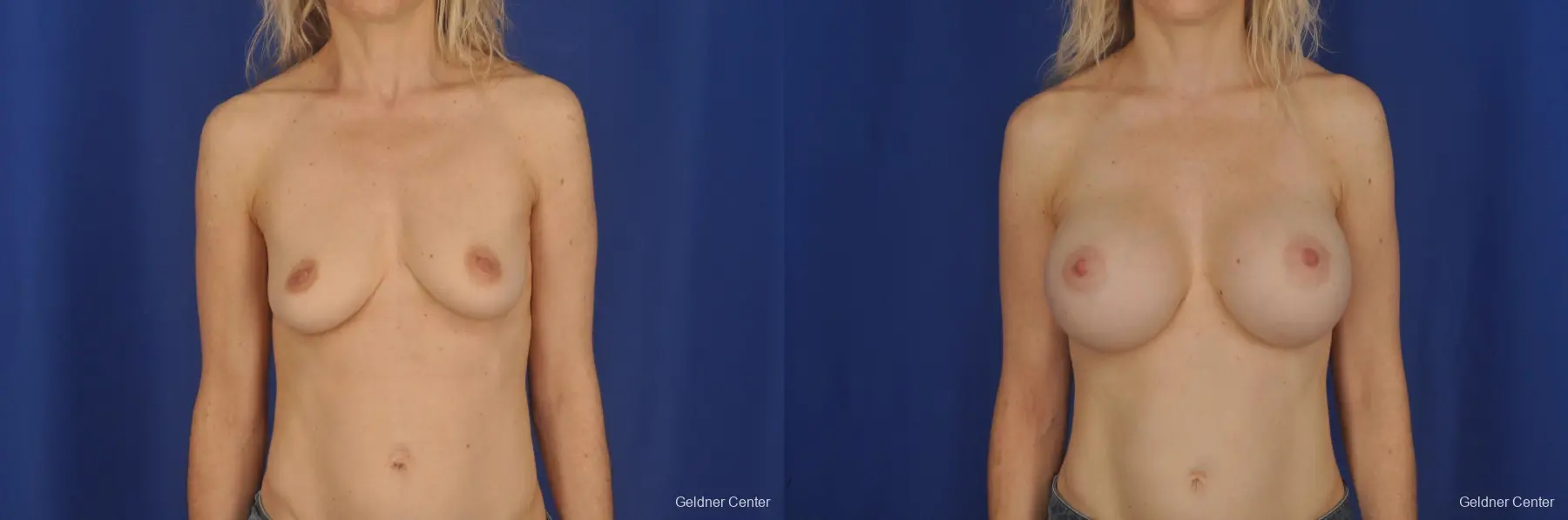 Breast Augmentation Lake Shore Dr, Chicago 2309 - Before and After