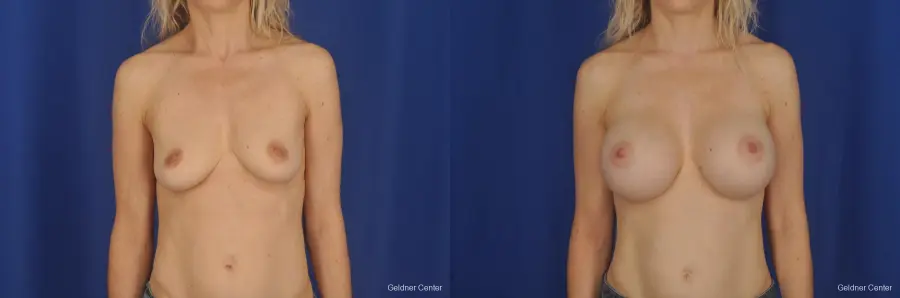 Breast Augmentation Lake Shore Dr, Chicago 2309 - Before and After 1
