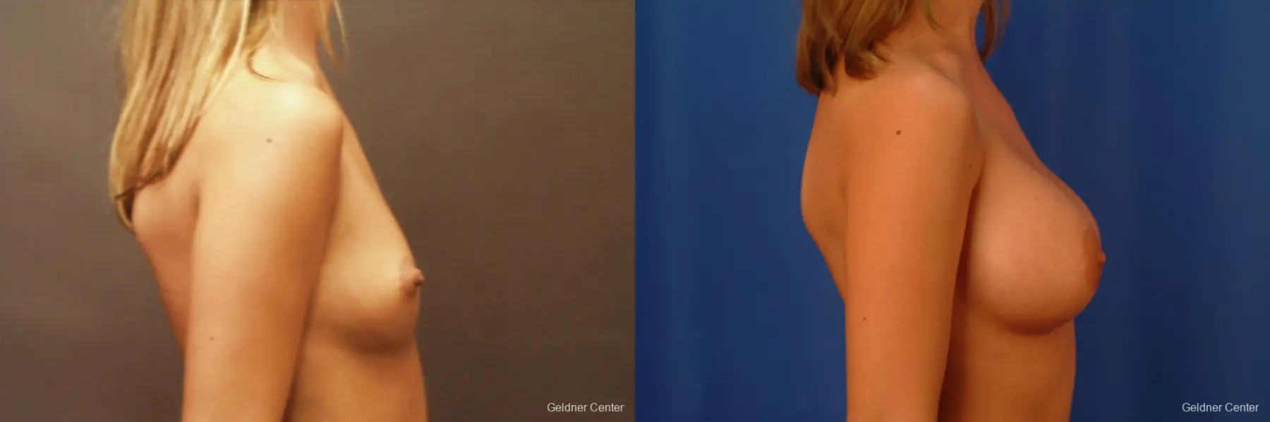 Breast Augmentation Lake Shore Dr, Chicago 2533 - Before and After 2