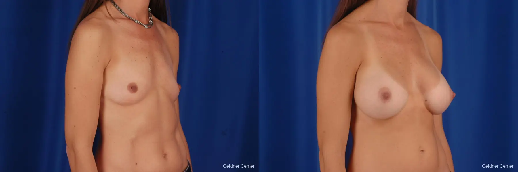 Chicago Breast Augmentation 2294 - Before and After 3
