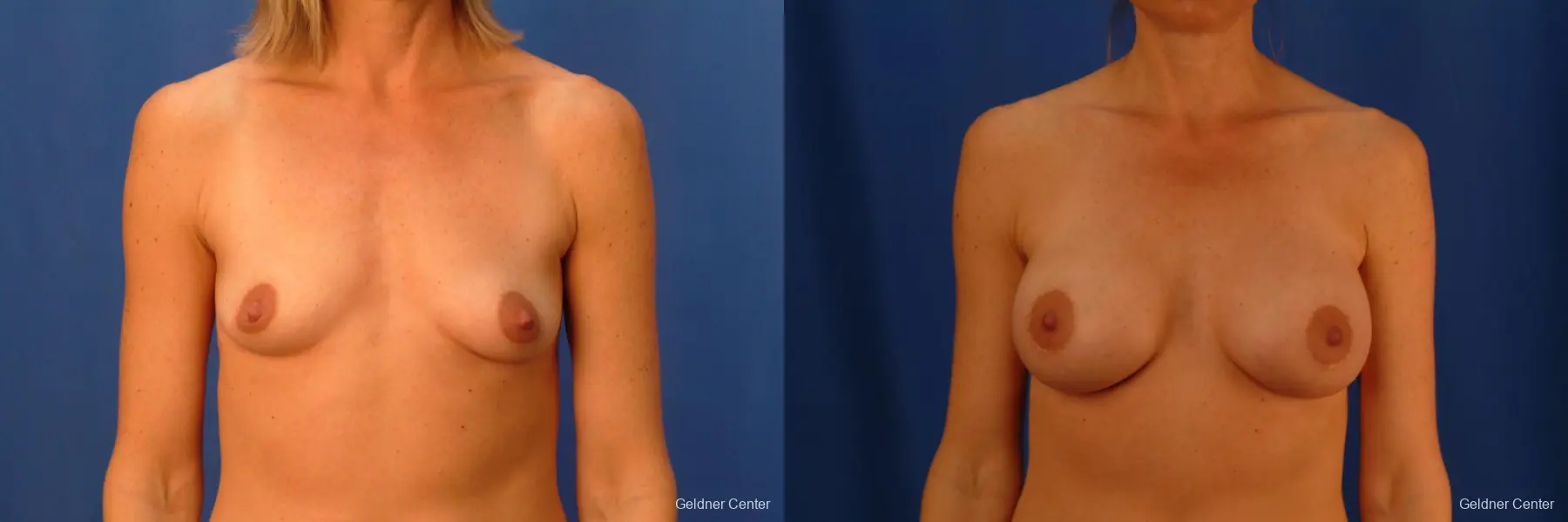 Breast Augmentation Lake Shore Dr, Chicago 2446 - Before and After 1