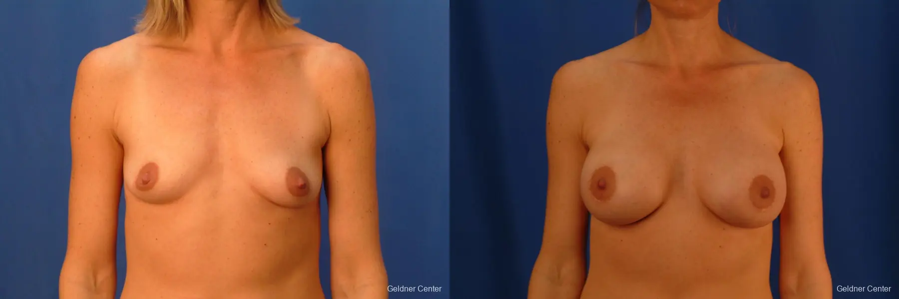 Breast Augmentation Lake Shore Dr, Chicago 2446 - Before and After