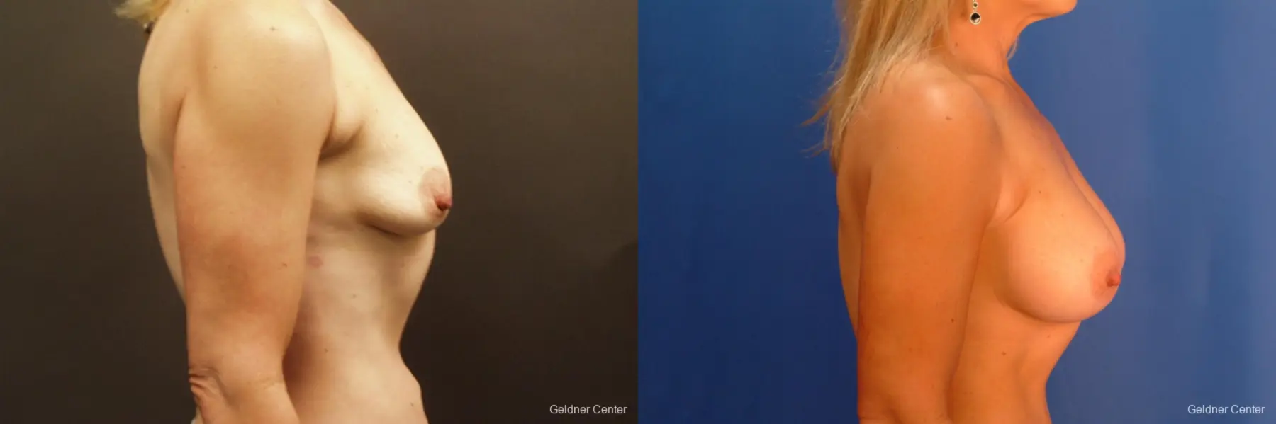 Breast Augmentation Hinsdale, Chicago 2632 - Before and After 2