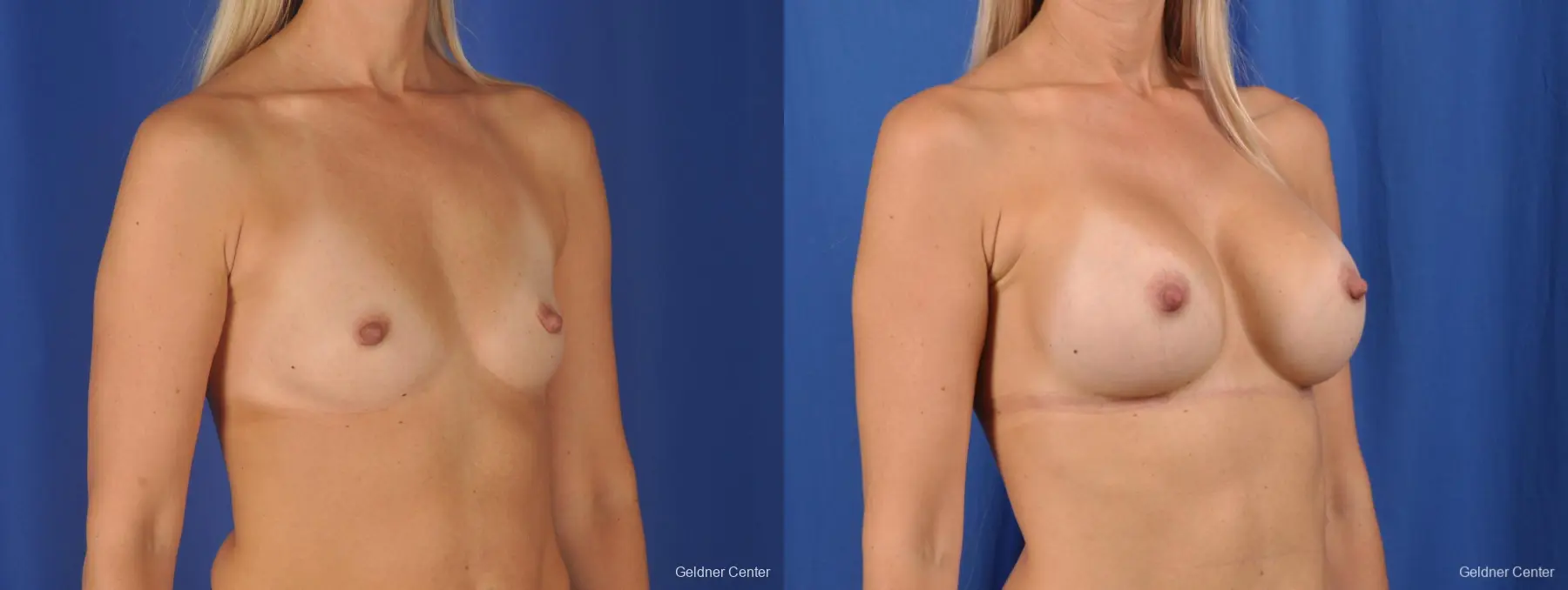 Breast Augmentation: Patient 149 - Before and After 2