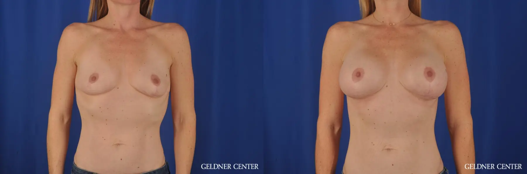 Chicago Breast Augmentation 4004 - Before and After