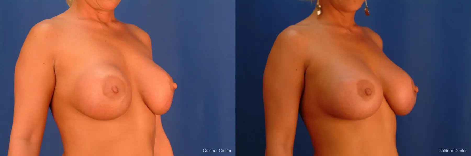 Breast Augmentation Hinsdale, Chicago 2427 - Before and After 3