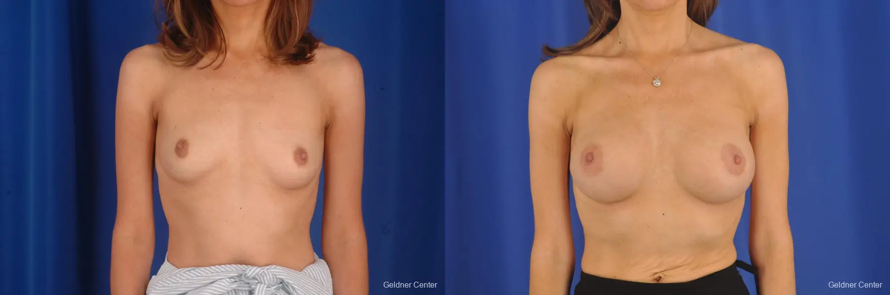 Breast Augmentation Lake Shore Dr, Chicago 2295 - Before and After 1