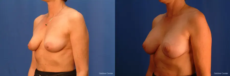 Breast Augmentation Streeterville, Chicago 2508 - Before and After 4