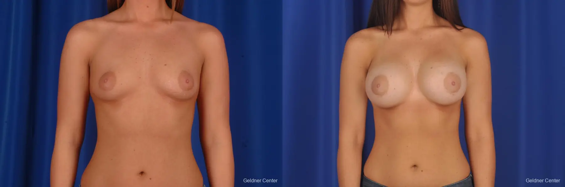 Chicago Breast Augmentation 2333 - Before and After 1