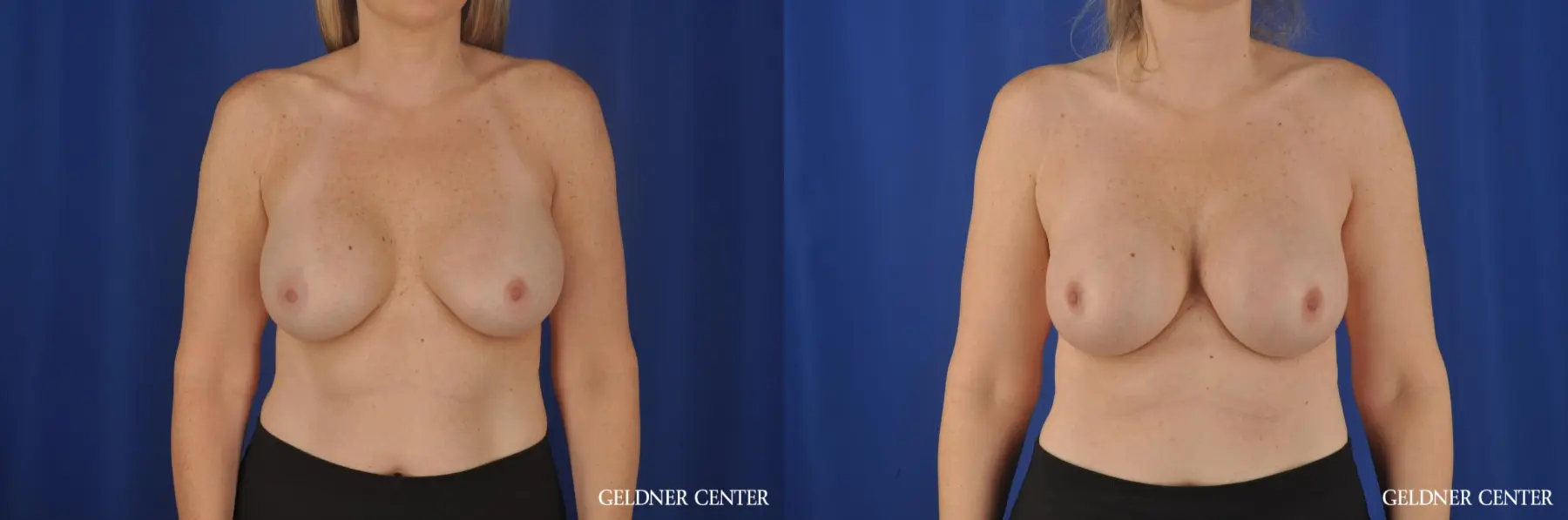 Breast Augmentation Streeterville, Chicago 8749 - Before and After